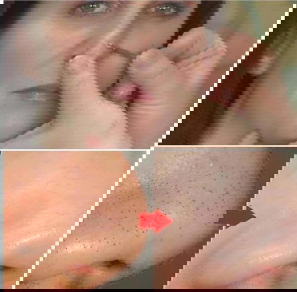 ابرة ازالة الرؤس السوداء Image 2 Preview