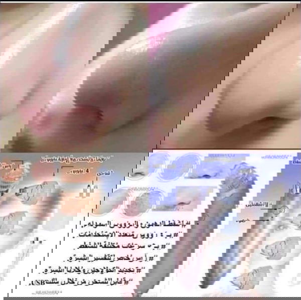 جهاز شفط الدهون Image 1 Preview