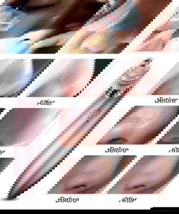 جهاز شفط الدهون Image 2 Preview