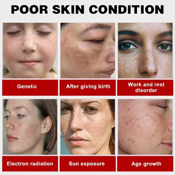 كريم Anti-Freckle Image 5 Preview