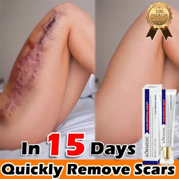 كريم معالج للندبات والاثار  Image 4 Preview
