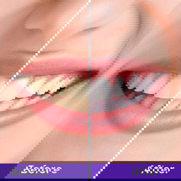 عرض حبتين جيل تبييض وتنظيف الاسنان السحري Image 5 Preview