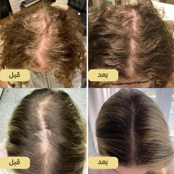  زيت طبيعي نباتي لنمو الشعر EELHOE Image 3 Preview