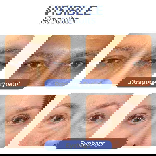 كريم التخلص من تجاعيد منطقة العين Image 4 Preview