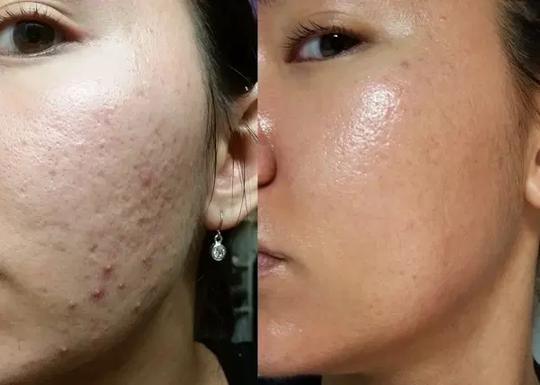 ديرما استامب - Derma Stamp Image 4 Preview